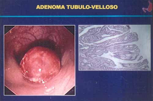 benignus adenoma