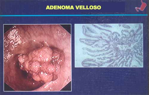 benignus adenoma